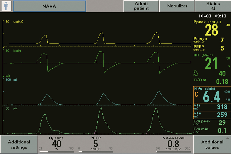 Getinge Neurally Adjusted Ventilatory Assist NAVA screen showing Edi signal the vital sign Getinge Neurally Adjusted Ventilatory Assist NAVA screen showing Edi signal the vital sign