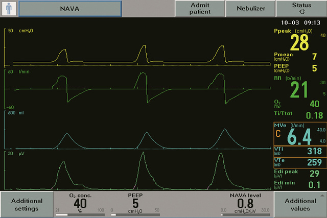 Getinge Neurally Adjusted Ventilatory Assist NAVA screen showing Edi signal the vital sign