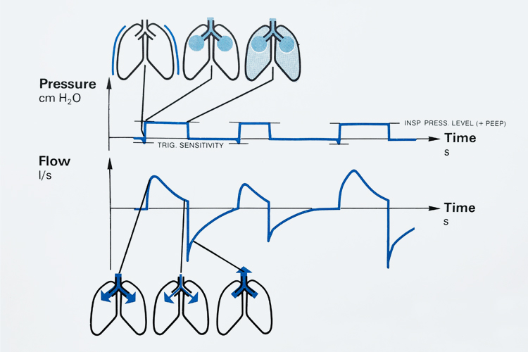 Graphic illustration depicting Pressure Support PS illustrating pressure and flow on vertical axis vs time on horizontal axis Graphic illustration depicting Pressure Support PS illustrating pressure and flow on vertical axis vs time on horizontal axis