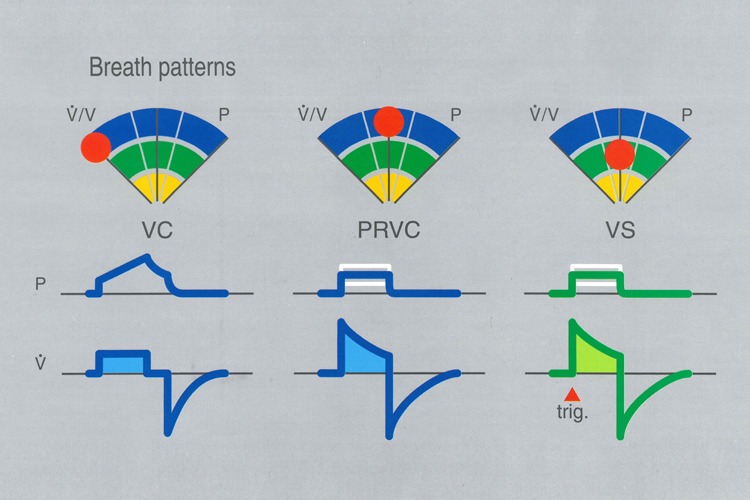 Graphic illustration depicting PRVC and VS Volume-targeted Ventilation breath patterns Graphic illustration depicting PRVC and VS Volume-targeted Ventilation breath patterns