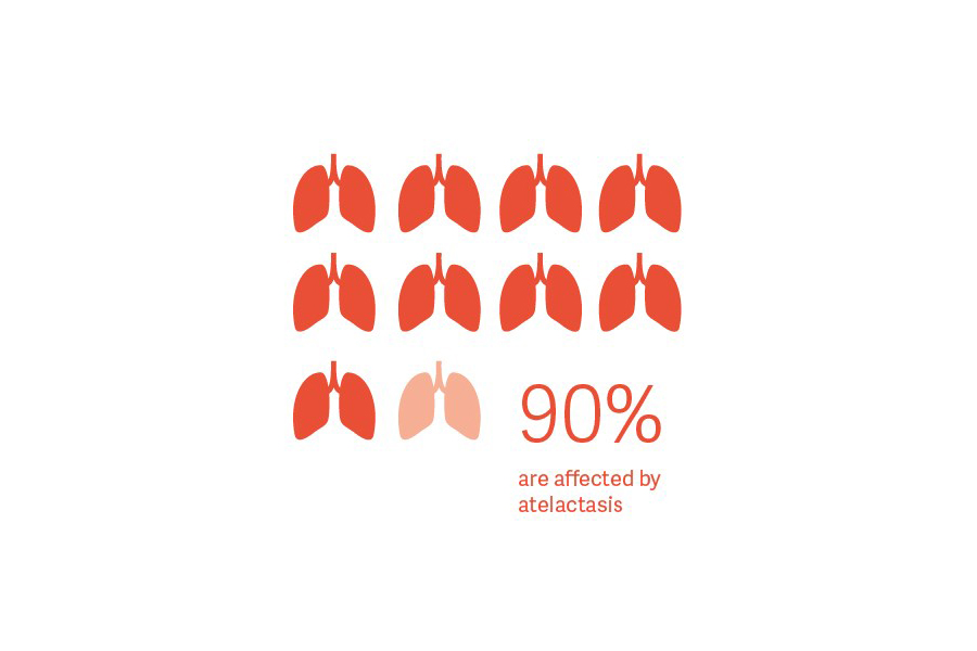 90% are affected by atelectasis 90% are affected by atelectasis