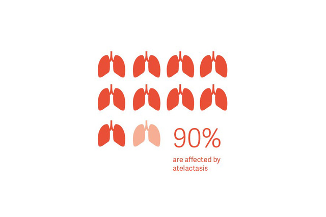 90% are affected by atelectasis